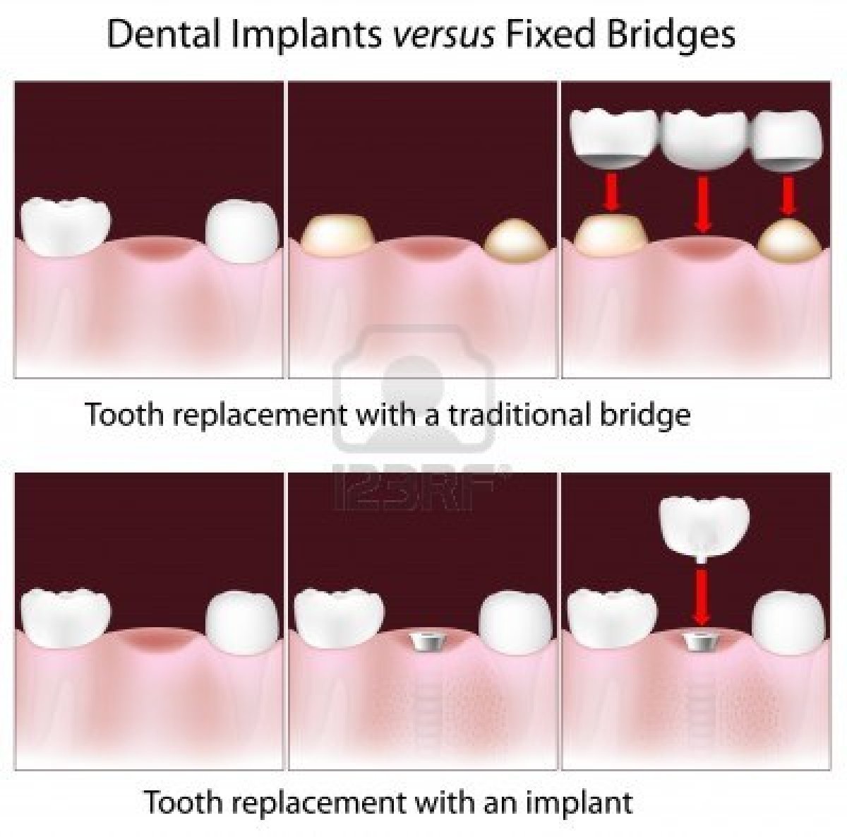 dental_bridge