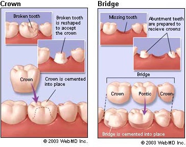 dental_crown