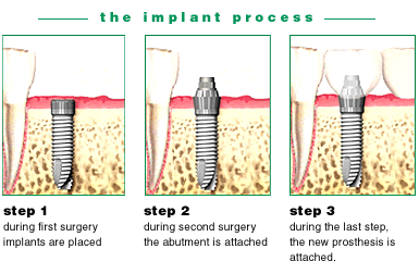 implant_process
