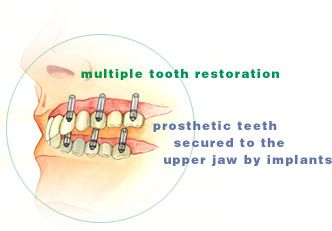 tooth_rehab